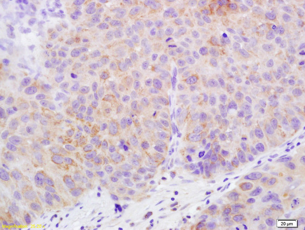 Formalin-fixed and paraffin embedded human bladder carcinoma labeled with Rabbit Anti-Claudin 17 Polyclonal Antibody, Unconjugated (bs-13751R) at 1:200 followed by conjugation to the secondary antibody and DAB staining