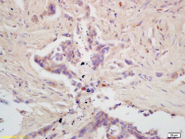 Formalin-fixed and paraffin embedded human colon carcinoma labeled with Rabbit Anti GPAM Polyclonal Antibody, Unconjugated (bs-5063R) at 1:200 followed by conjugation to the secondary antibody and DAB staining