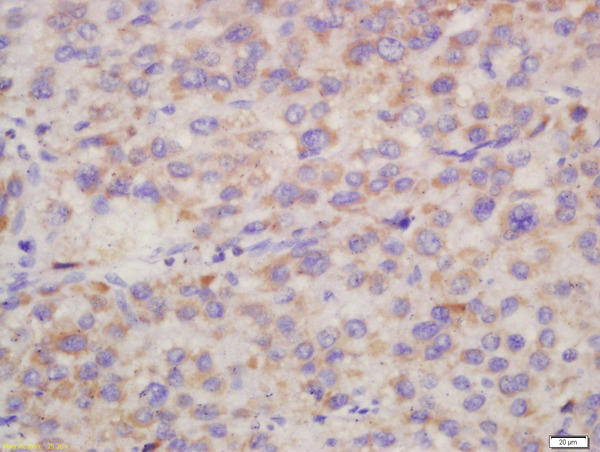 Formalin-fixed and paraffin embedded human liver carcinoma labeled with Rabbit Anti-Hepsin Polyclonal Antibody, Unconjugated (bs-6281R) at 1:200 followed by conjugation to the secondary antibody and DAB staining