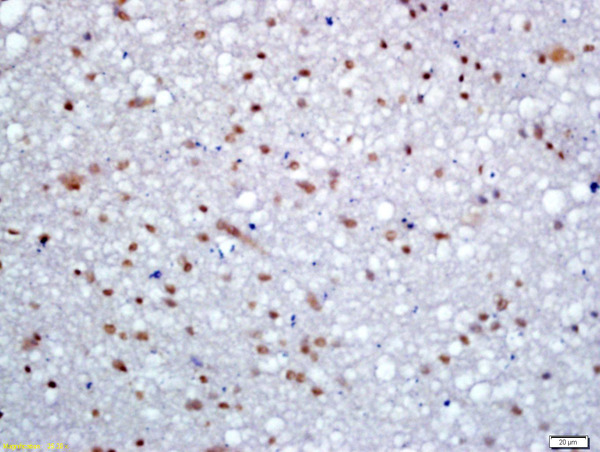 Formalin-fixed and paraffin embedded human glioma labeled with Rabbit Anti-KDM5B Polyclonal Antibody, Unconjugated (bs-6139R) at 1:200 followed by conjugation to the secondary antibody and DAB staining\n