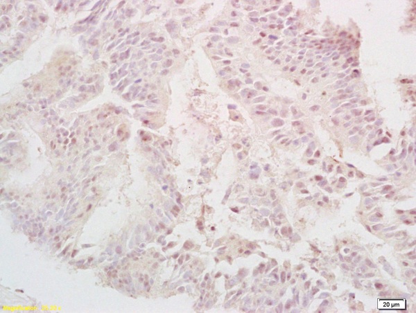 Formalin-fixed and paraffin embedded human colon carcinoma labeled with Rabbit Anti-TGF alpha Polyclonal Antibody (bs-0066R) at 1:200 followed by conjugation to the secondary antibody and DAB staining.
