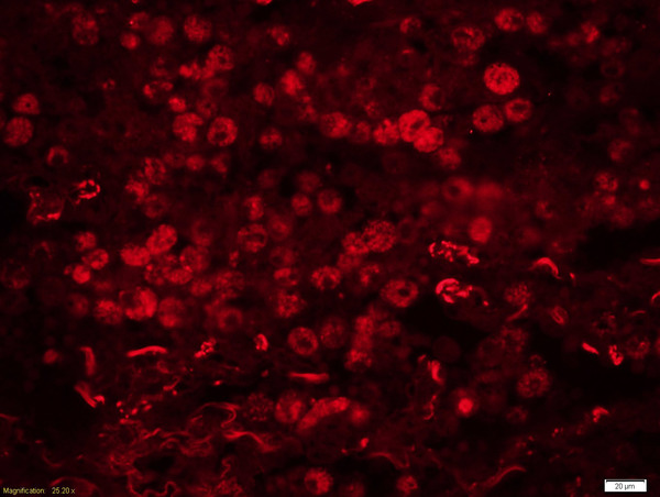 Formalin-fixed and paraffin embedded human lung carcinoma labeled with Rabbit Anti-GADD45B Polyclonal Antibodyy, Unconjugated (bs-5904R) at 1:200 followed by conjugation to the secondary antibody Goat Anti-Rabbit IgG, Cy3 conjugated(bs-0295G-Cy3)used at 1:200 dilution for 40 minutes at 37°C.