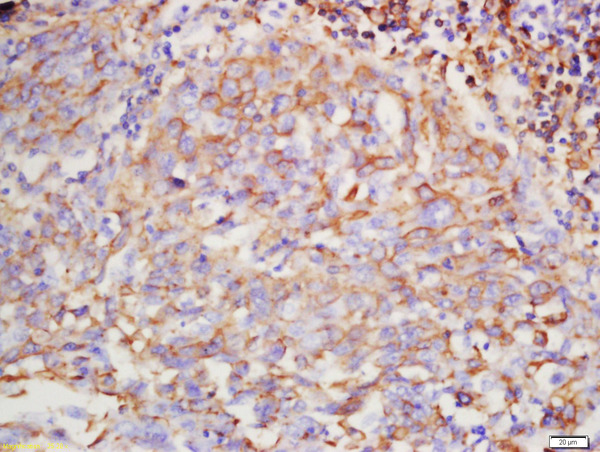 Formalin-fixed and paraffin embedded human lung carcinoma labeled with Rabbit Anti-Hyaluronidase2 Polyclonal Antibody, Unconjugated (bs-5888R) at 1:200 followed by conjugation to the secondary antibody and DAB staining