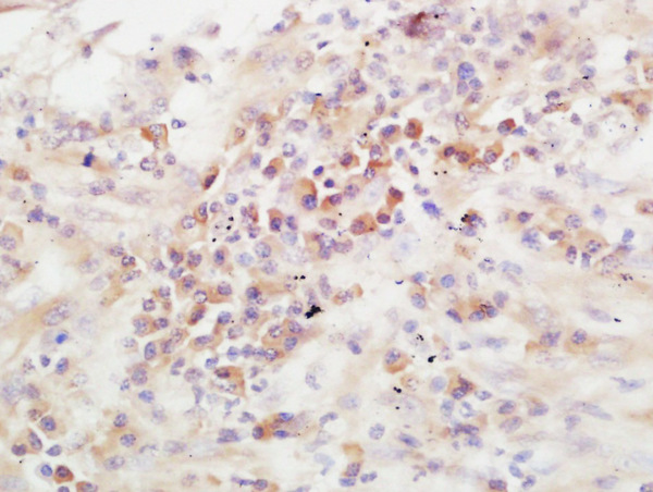 Formalin-fixed and paraffin embedded human lung carcinoma labeled with Rabbit Anti-ADAMTS13 Polyclonal Antibody, Unconjugated (bs-5856R) at 1:200 followed by conjugation to the secondary antibody and DAB staining