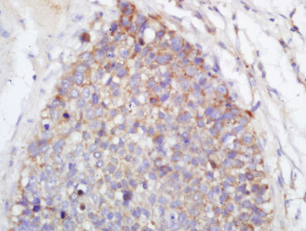 Formalin-fixed and paraffin embedded human lung carcinoma labeled with Anti-TLR2 Polyclonal Antibody, Unconjugated (bs-10472R) at 1:200 followed by conjugation to the secondary antibody and DAB staining