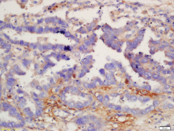 Formalin-fixed and paraffin embedded human lung carcinoma labeled with Anti-IL-12 beta Polyclonal Antibody, Unconjugated (bs-10641R) at 1:200 followed by conjugation to the secondary antibody and DAB staining.