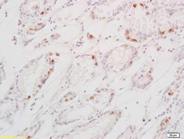 Formalin-fixed and paraffin embedded human gastric carcinoma  labeled with Anti-TGF alpha Polyclonal Antibody, Unconjugated (bs-0066R) at 1:200 followed by conjugation to the secondary antibody and DAB staining