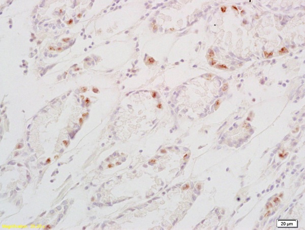 Formalin-fixed and paraffin embedded human gastric carcinoma labeled with Anti-TGF alpha Polyclonal Antibody, Unconjugated (bs-0066R) at 1:200 followed by conjugation to the secondary antibody and DAB staining