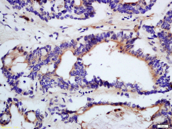 Formalin-fixed and paraffin embedded human colon cancer tissue labeled with Rabbit Anti-DHDH Polyclonal Antibody, Unconjugated (bs-14302R) at 1:200 followed by conjugation to the secondary antibody and DAB staining