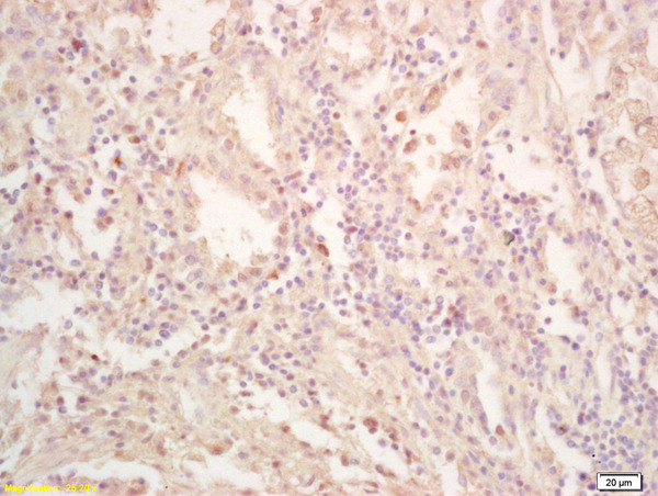 Formalin-fixed and paraffin embedded human gastric carcinoma labeled with Rabbit Anti FES Polyclonal Antibody, Unconjugated (bs-5750R) at 1:200 followed by conjugation to the secondary antibody and DAB staining