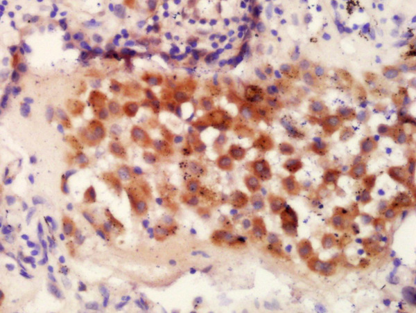 Formalin-fixed and paraffin embedded Human lung carcinoma tissue labeled with Anti-IRF9 Polyclonal Antibody, Unconjugated (bs-18169R) at 1:300 followed by conjugation to the secondary antibody and DAB staining