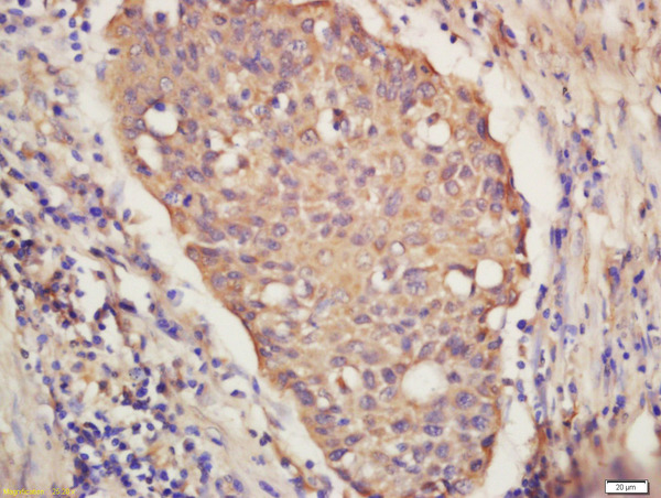 Formalin-fixed and paraffin embedded Human lung carcinoma labeled with Anti-IRF9 Polyclonal Antibody, Unconjugated (bs-18169R) at 1:300 followed by conjugation to the secondary antibody and DAB staining