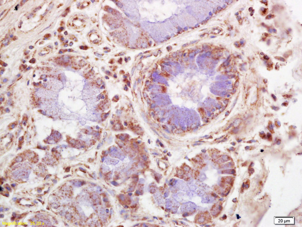 Formalin-fixed and paraffin embedded human lung carcinoma labeled with Rabbit Anti NUAK2 Polyclonal Antibody, Unconjugated (bs-4019R) at 1:200 followed by conjugation to the secondary antibody and DAB staining