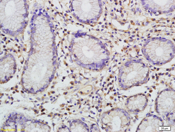 Formalin-fixed and paraffin embedded human gastric carcinoma labeled with Rabbit Anti-CCL1 Polyclonal Antibody, Unconjugated (bs-10709R) at 1:200 followed by conjugation to the secondary antibody and DAB staining