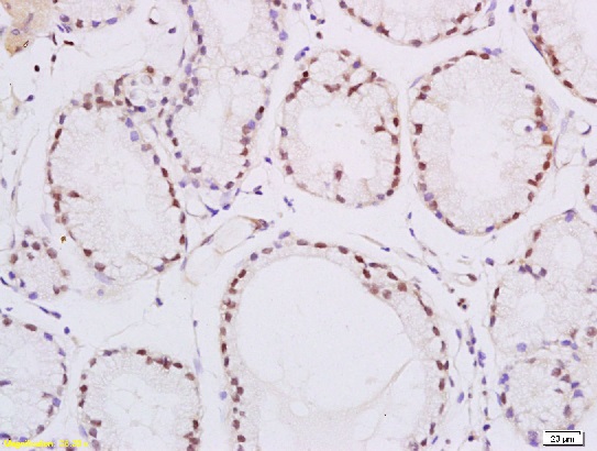 Formalin-fixed and paraffin embedded human esophageal carcinoma labeled with Rabbit Anti-PPAR delta Polyclonal Antibody, Unconjugated (bs-0250R) at 1:200 followed by conjugation to the secondary antibody and DAB staining\\n