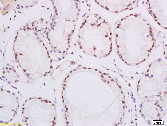 Formalin-fixed and paraffin embedded human esophageal carcinoma labeled with Rabbit Anti-PPAR delta Polyclonal Antibody, Unconjugated (bs-0250R) at 1:200 followed by conjugation to the secondary antibody and DAB staining\n