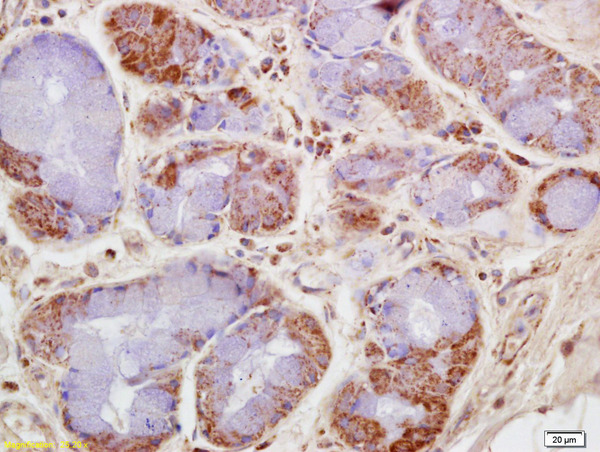 Formalin-fixed and paraffin embedded human lung carcinoma labeled with Rabbit Anti CKMT/Creatine kinase MT Polyclonal Antibody, Unconjugated (bs-6522R) at 1:200 followed by conjugation to the secondary antibody and DAB staining