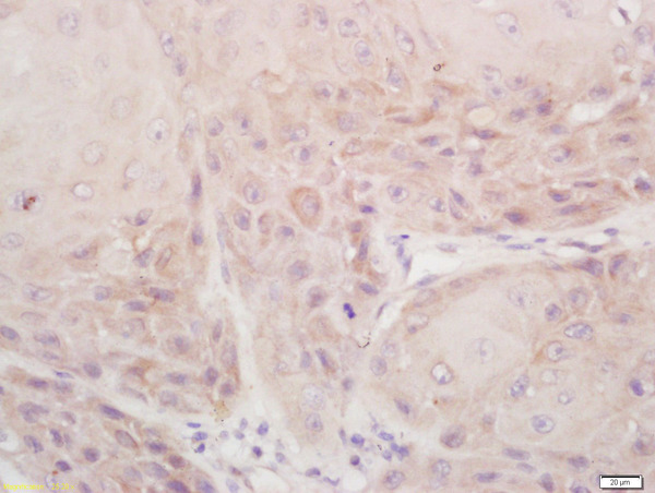 Formalin-fixed and paraffin embedded human laryngocarcinoma labeled with Rabbit Anti-DSPP Polyclonal Antibody, Unconjugated (bs-10316R) at 1:200 followed by conjugation to the secondary antibody and DAB staining