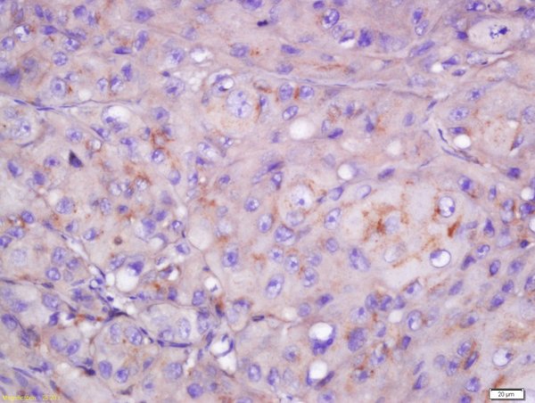 Formalin-fixed and paraffin embedded human laryngeal tissue labeled with Rabbit Anti-CYB5R4 Polyclonal Antibody, Unconjugated (bs-14133R) at 1:200 followed by conjugation to the secondary antibody and DAB staining Formalin-fixed and paraffin embedded human laryngeal tissue labeled with Rabbit Anti-CYB5R4 Polyclonal Antibody, Unconjugated (bs-14133R) at 1:200 followed by conjugation to the secondary antibody and DAB staining