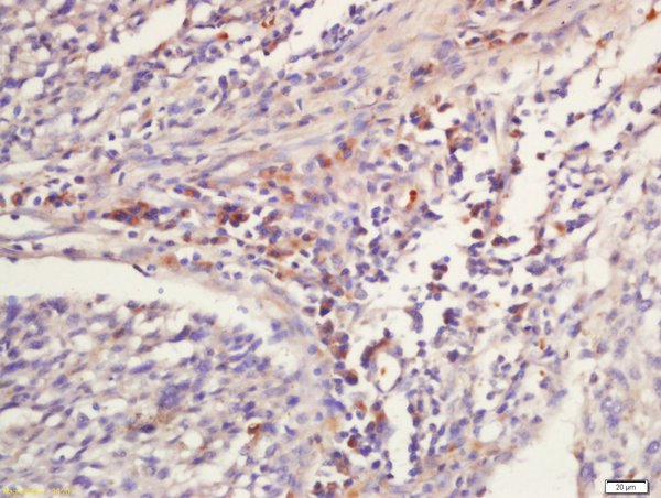 paraformaldehyde-fixed, paraffin embedded human laryngocarcinoma tissue; Antigen retrieval with 0.01M citrate buffer(pH6) boiling for 15 minutes; Block endogenous peroxidase by 3% hydrogen peroxide for 30 minutes; Blocking buffer (normal goat serum) at 37°C for 20min; Antibody incubation with Rabbit Anti-GNLY/NKG5 Polyclonal Antibody, Unconjugated (bs-2577R) at 1:200 overnight at 4°C, followed by a conjugated secondary and DAB staining