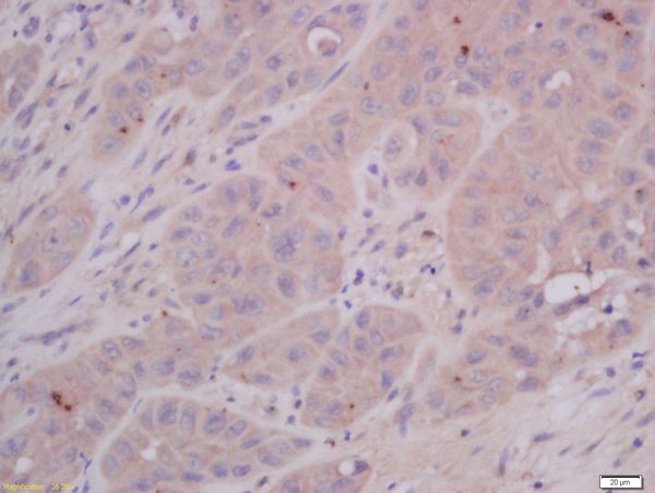Formalin-fixed and paraffin embedded human laryngocarcinoma tissue labeled with Anti-COMMD4 Polyclonal Antibody, Unconjugated(bs-8037R) 1:400 followed by conjugation to the secondary antibody and DAB staining.