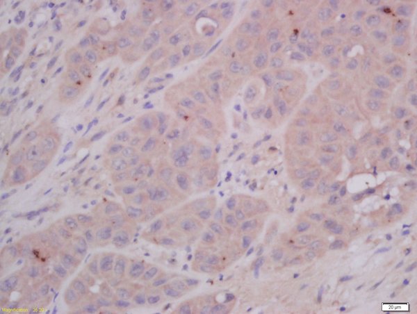 Formalin-fixed and paraffin embedded human laryngocarcinoma tissue labeled with Anti-COMMD4 Polyclonal Antibody, Unconjugated(bs-8037R) 1:400 followed by conjugation to the secondary antibody and DAB staining. Formalin-fixed and paraffin embedded human laryngocarcinoma tissue labeled with Anti-COMMD4 Polyclonal Antibody, Unconjugated(bs-8037R) 1:400 followed by conjugation to the secondary antibody and DAB staining.