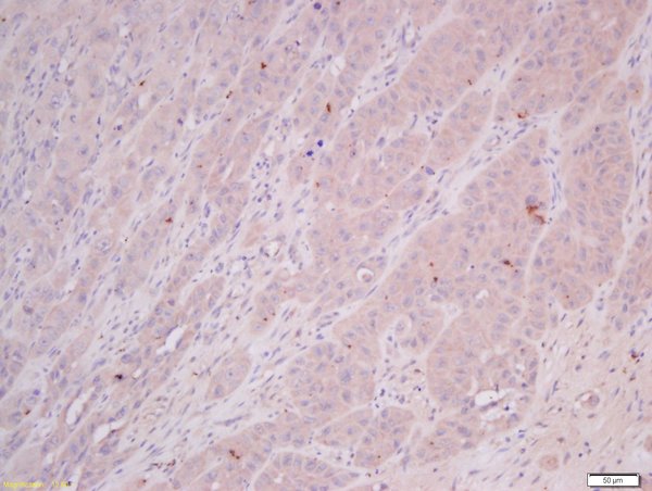Formalin-fixed and paraffin embedded human laryngocarcinoma tissue labeled with Anti-COMMD4 Polyclonal Antibody, Unconjugated(bs-8037R) 1:400 followed by conjugation to the secondary antibody and DAB staining.