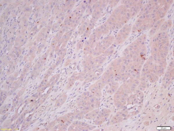 Formalin-fixed and paraffin embedded human laryngocarcinoma tissue labeled with Anti-COMMD4 Polyclonal Antibody, Unconjugated(bs-8037R) 1:400 followed by conjugation to the secondary antibody and DAB staining. Formalin-fixed and paraffin embedded human laryngocarcinoma tissue labeled with Anti-COMMD4 Polyclonal Antibody, Unconjugated(bs-8037R) 1:400 followed by conjugation to the secondary antibody and DAB staining.