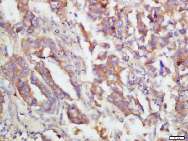 Formalin-fixed and paraffin embedded human lung carcinoma labeled with Rabbit Anti-MKK3(Ser218)/MKK6(Ser207) Polyclonal Antibody, Unconjugated (bs-3274R) at 1:200 followed by conjugation to the secondary antibody and DAB staining\n