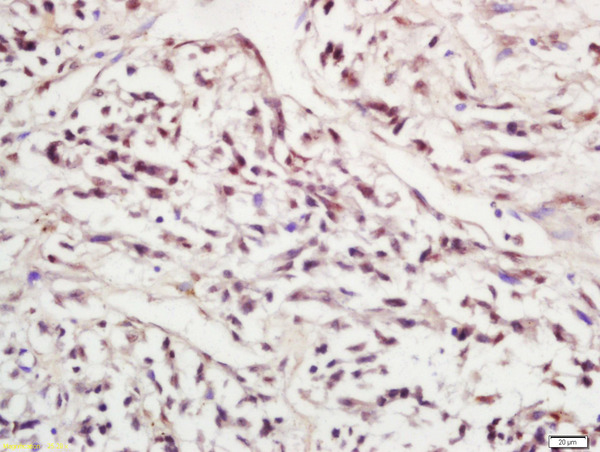 Formalin-fixed and paraffin embedded human lung carcinoma labeled with Rabbit Anti-SIRT1(Ser47) Polyclonal Antibody, Unconjugated(bs-3393R) 1:200 followed by conjugation to the secondary antibody and DAB staining\n