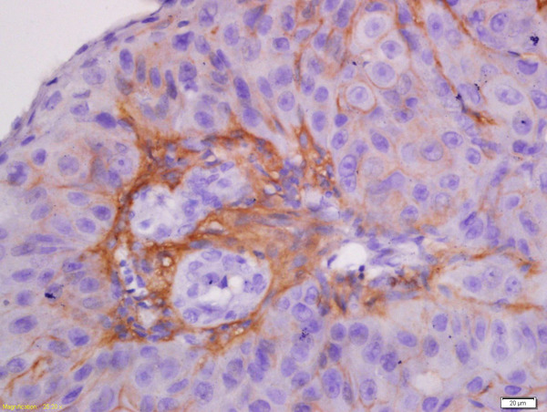 Formalin-fixed and paraffin embedded human laryngocarcinoma labeled with Anti-CK7 Polyclonal Antibody, Unconjugated (bs-1610R) at 1:300 followed by conjugation to the secondary antibody and DAB staining.