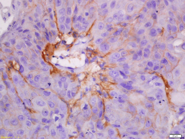 Formalin-fixed and paraffin embedded human laryngocarcinoma labeled with Anti-CK7 Polyclonal Antibody, Unconjugated (bs-1610R) at 1:300 followed by conjugation to the secondary antibody and DAB staining.