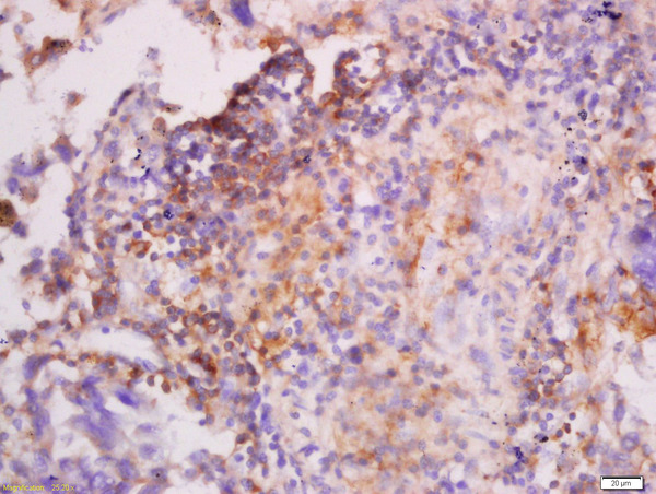 Formalin-fixed and paraffin embedded human lung carcinoma labeled with Anti-CK7 Polyclonal Antibody, Unconjugated (bs-1610R) at 1:300 followed by conjugation to the secondary antibody and DAB staining.
