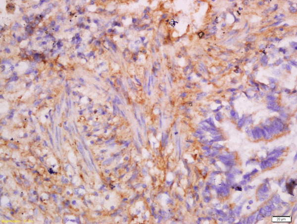 Formalin-fixed and paraffin embedded human lung carcinoma labeled with Anti-CK7 Polyclonal Antibody, Unconjugated (bs-1610R) at 1:300 followed by conjugation to the secondary antibody and DAB staining.