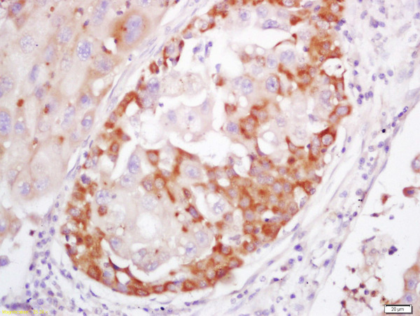 Formalin-fixed and paraffin embedded human lung cancer labeled with Rabbit Anti-S100A4 Polyclonal Antibody, Unconjugated(bs-3759R) 1:200 followed by conjugation to the secondary antibody and DAB staining