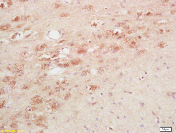 Formalin-fixed and paraffin embedded human colon cancer labeled with Anti-TRH Polyclonal Antibody, Unconjugated (bs-0357R) at 1:200 followed by conjugation to the secondary antibody and DAB staining