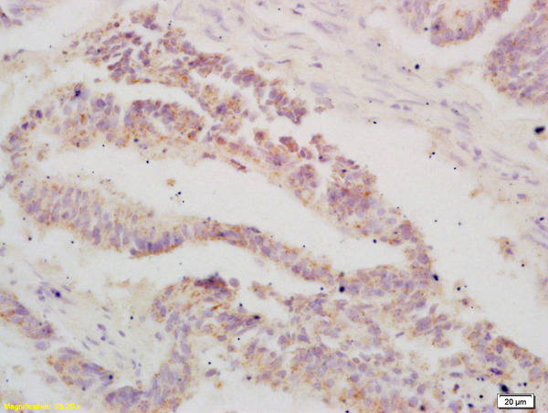 Formalin-fixed and paraffin embedded human colon carcinoma labeled with Anti-ATF3 Polyclonal Antibody, Unconjugated (bs-0519R) at 1:200 followed by conjugation to the secondary antibody and DAB staining