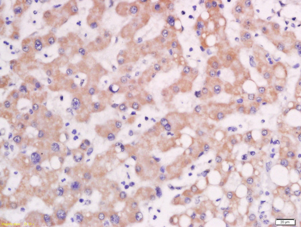 Formalin-fixed and paraffin embedded human lung carcinoma labeled with Rabbit Anti-AP1M2 Polyclonal Antibody, Unconjugated (bs-13638R) at 1:200 followed by conjugation to the secondary antibody and DAB staining