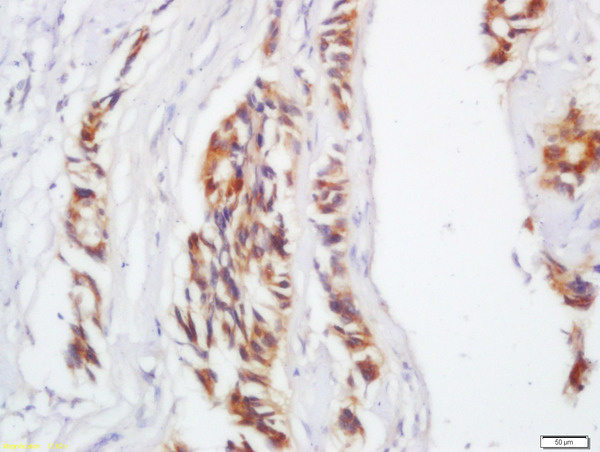 Formalin-fixed and paraffin embedded human colon carcinoma labeled with Anti-IL-17C Polyclonal Antibody, Unconjugated (bs-2611R) at 1:200 followed by conjugation to the secondary antibody and DAB staining.