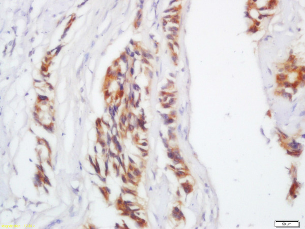 Formalin-fixed and paraffin embedded human colon carcinoma labeled with Anti-IL-17C Polyclonal Antibody, Unconjugated (bs-2611R) at 1:200 followed by conjugation to the secondary antibody and DAB staining. Formalin-fixed and paraffin embedded human colon carcinoma labeled with Anti-IL-17C Polyclonal Antibody, Unconjugated (bs-2611R) at 1:200 followed by conjugation to the secondary antibody and DAB staining.