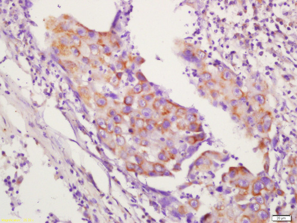 Formalin-fixed and paraffin embedded human lung carcinoma labeled with Anti-CD134 Polyclonal Antibody, Unconjugated (bs-2685R) followed by conjugation to the secondary antibody and DAB staining.