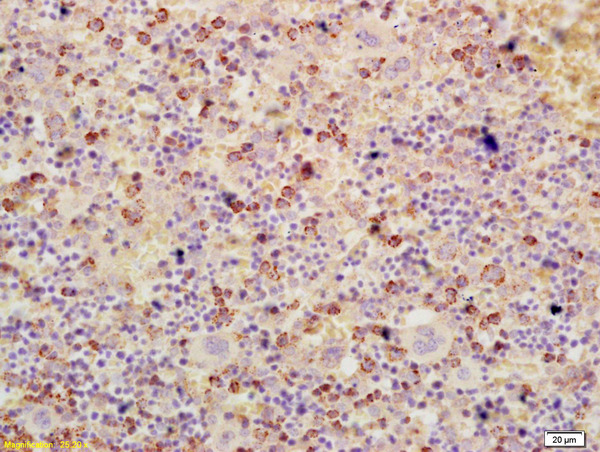 Formalin-fixed and paraffin embedded human colon cancer labeled with Anti-ATF3 Polyclonal Antibody, Unconjugated (bs-0519R) at 1:200 followed by conjugation to the secondary antibody and DAB staining