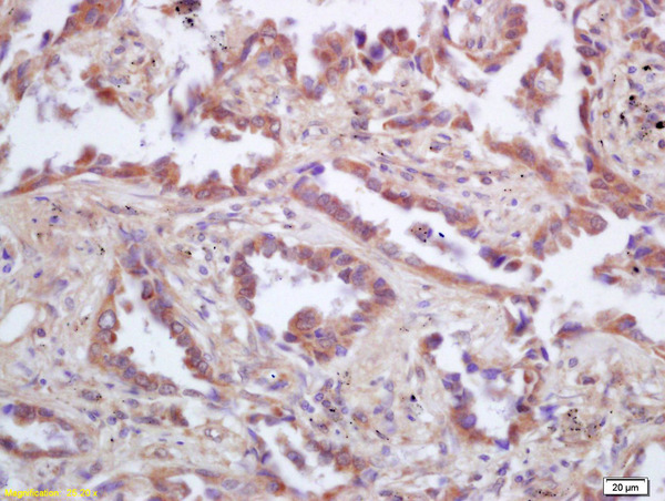 Formalin-fixed and paraffin embedded human lung carcinoma labeled with Rabbit Anti p53AIP1 Polyclonal Antibody, Unconjugated (bs-7094R) at 1:200 followed by conjugation to the secondary antibody and DAB staining