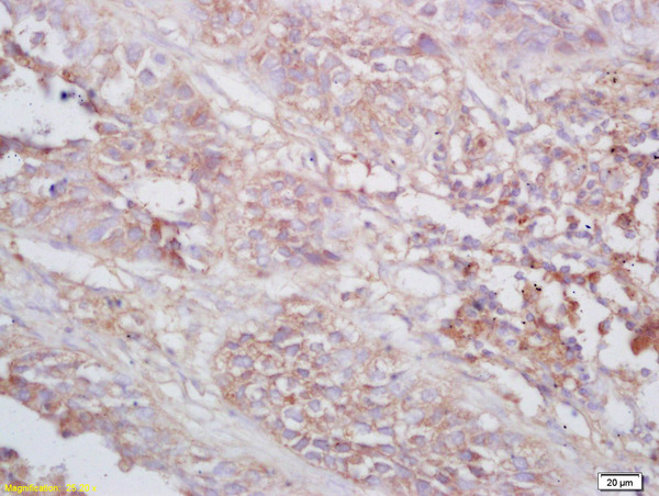 Formalin-fixed and paraffin embedded human lung carcinoma labeled with Rabbit Anti TNMD/tenomodulin Polyclonal Antibody, Unconjugated (bs-7525R) at 1:200 followed by conjugation to the secondary antibody and DAB staining Formalin-fixed and paraffin embedded human lung carcinoma labeled with Rabbit Anti TNMD/tenomodulin Polyclonal Antibody, Unconjugated (bs-7525R) at 1:200 followed by conjugation to the secondary antibody and DAB staining