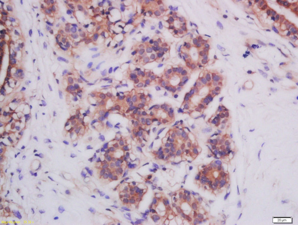 Formalin-fixed and paraffin embedded human breast cancer tissue labeled with Anti-Mitofusin 2 Polyclonal Antibody, Unconjugated (bs-2988R) at 1:200 followed by conjugation to the secondary antibody and DAB staining.
