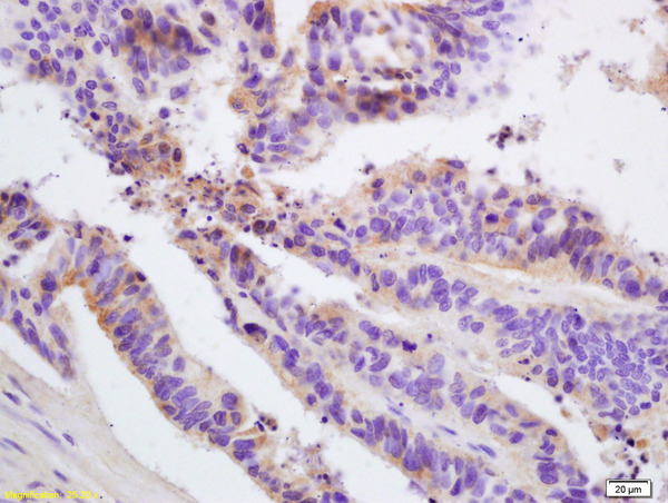 Formalin-fixed and paraffin embedded human colon carcinoma labeled with Rabbit Anti FIS1/TTC11 Polyclonal Antibody, Unconjugated (bs-7646R) at 1:200 followed by conjugation to the secondary antibody and DAB staining