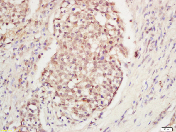 Formalin-fixed and paraffin embedded human laryngeal tissue labeled with Anti-DNA Polymerase gamma Polyclonal Antibody, Unconjugated (bs-13017R) at 1:200 followed by conjugation to the secondary antibody and DAB staining.