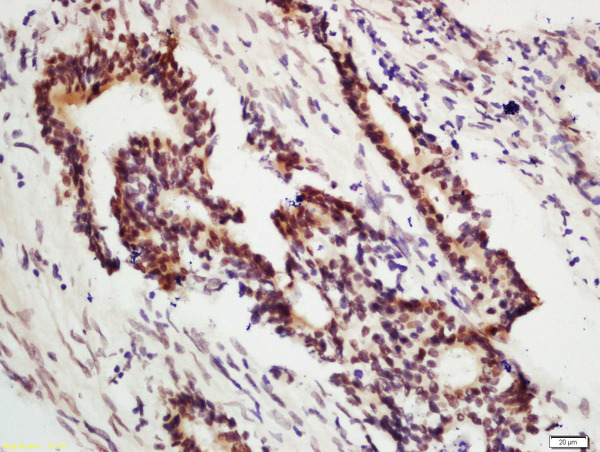 Formalin-fixed and paraffin embedded human colon carcinoma labeled with Anti-DNA Polymerase gamma Polyclonal Antibody, Unconjugated (bs-13017R) at 1:200 followed by conjugation to the secondary antibody and DAB staining.
