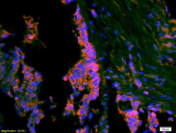 Formalin-fixed and paraffin-embedded rat brain labeled with Anti-ATF3 Polyclonal Antibody, Unconjugated(bs-0519R) 1:200, overnight at 4°C, The secondary antibody was Goat Anti-Rabbit IgG, Cy3 conjugated(bs-0295G-Cy3)used at 1:200 dilution for 40 minutes at 37°C.