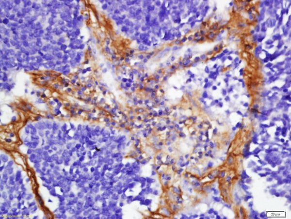 Formalin-fixed and paraffin embedded human lung carcinoma labeled with Anti-FHOD1 Polyclonal Antibody, Unconjugated (bs-13158R) at 1:200 followed by conjugation to the secondary antibody and DAB staining